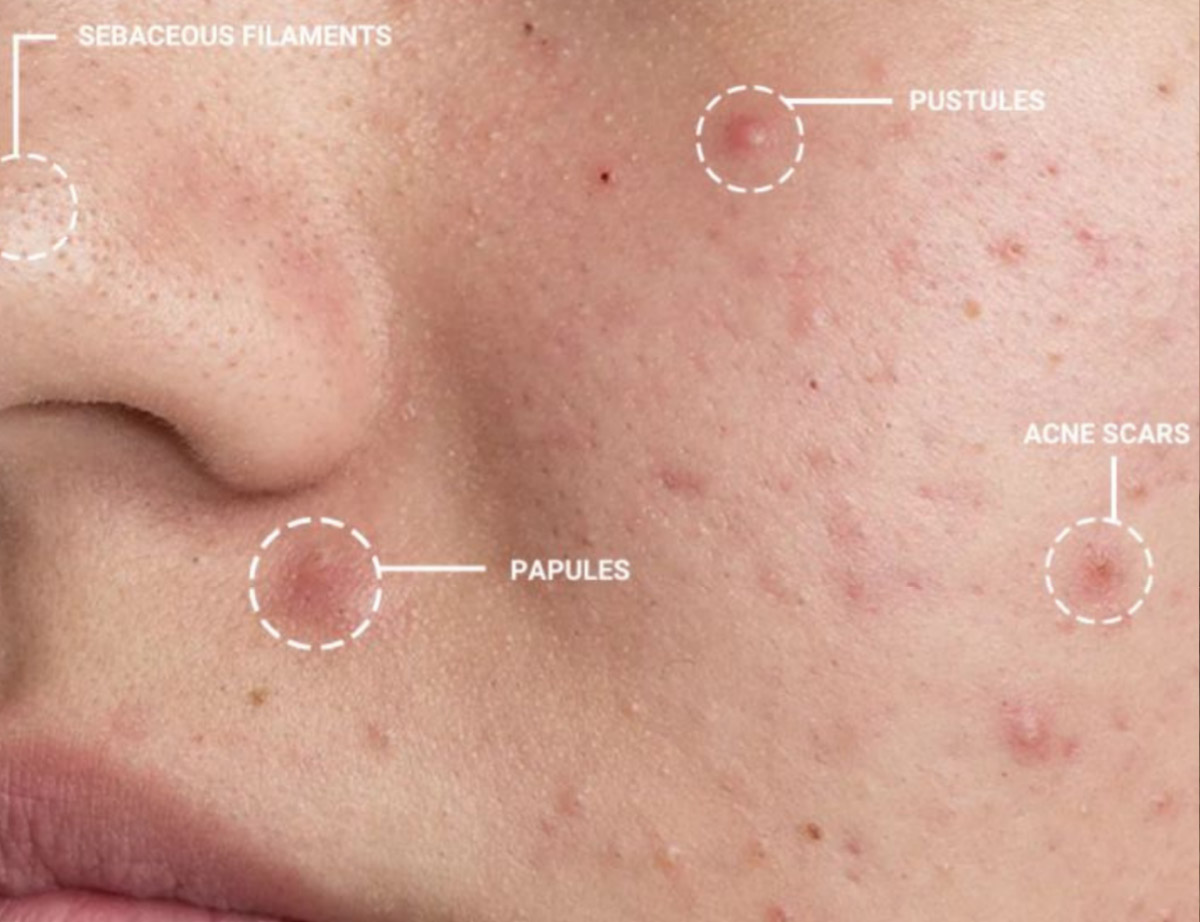 Acne Removing  Essence