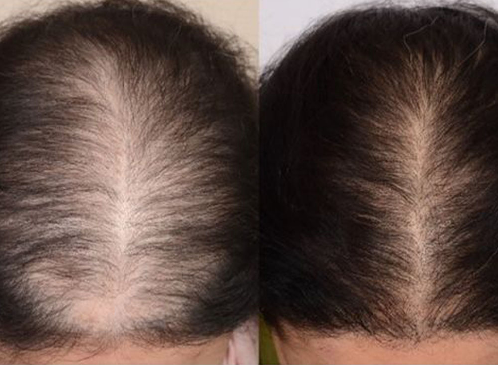 Hair loss prevention shampoo Hair loss prevention shampoo