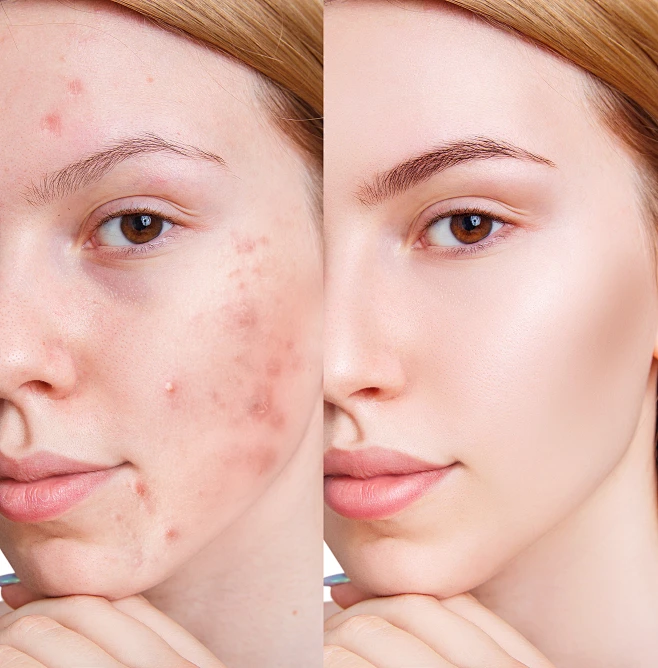 Wholesaler Source Acne Treatment | Bulk Professional Acne Skincare Solutions